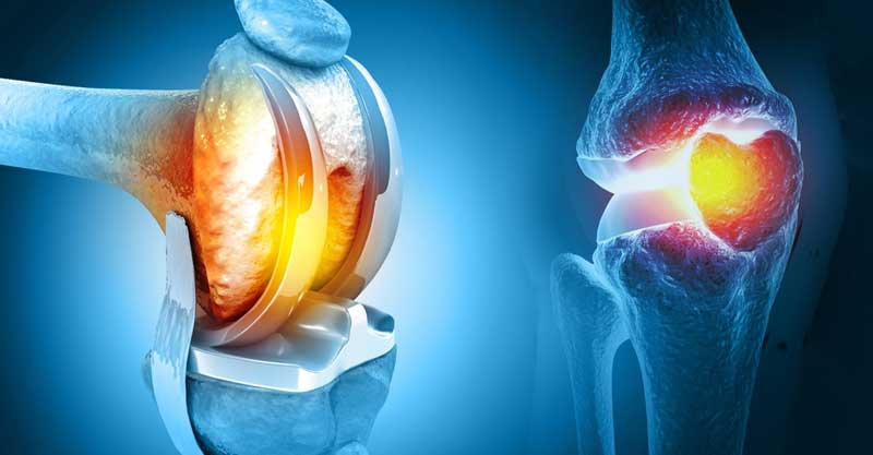 Hip Replacement, Knee Joint Replacement